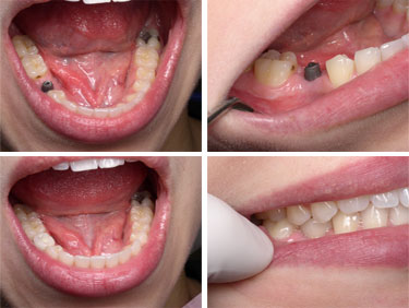 implants implant dental tooth cost toronto markham molar teeth single procedure permanent lower before true understanding clinic dentis treatments restored