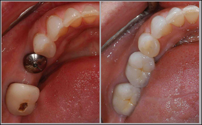 dental implants implant molar lower crown dr dentistry dentures teeth surgery missing dentist technology bridges ex stays cutting edge consultation