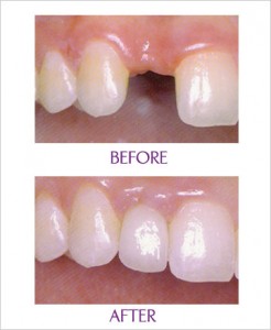 cosmetic implant clinical
