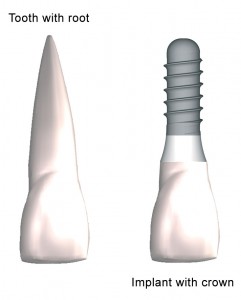 Dental Implants