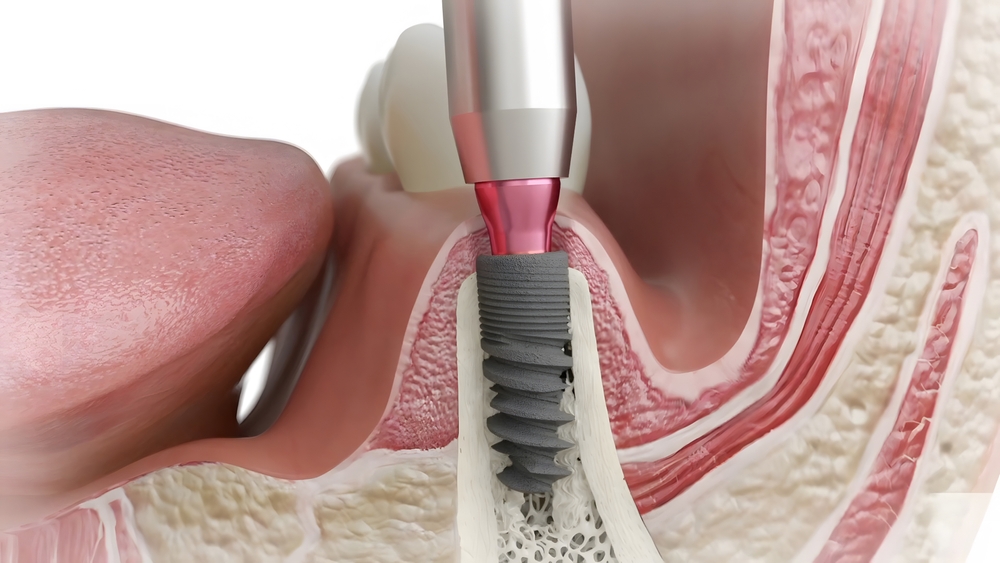 Dental implant precisely placed in alveolar bone
